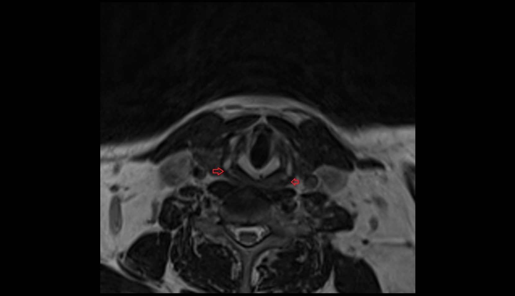 Inferior pharyngeal constrictor muscle mri axial image