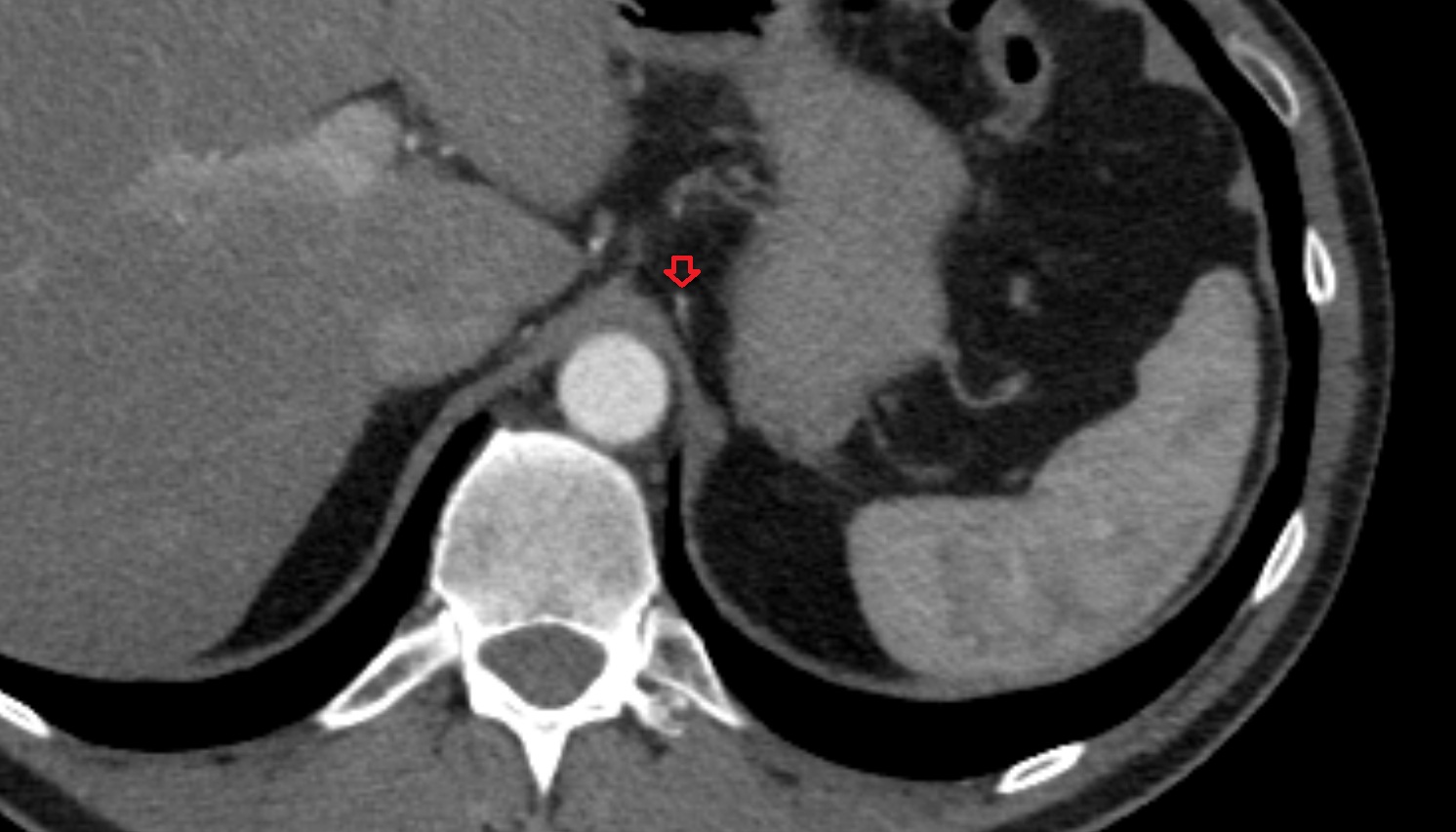 Inferior phrenic artery  anatomy CT axial  image -img-00000-00000
