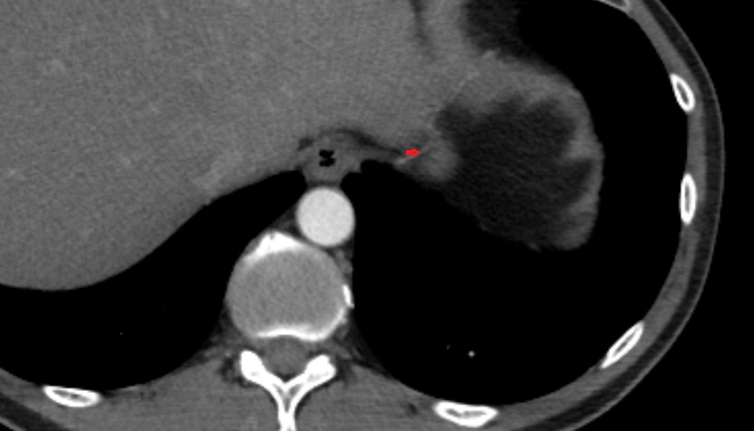 Inferior phrenic artery  anatomy CT axial  image -img-00000-00000_00001