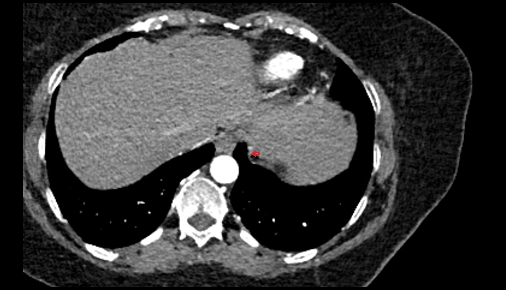 Inferior phrenic vein CT AXIAL IMAGE
