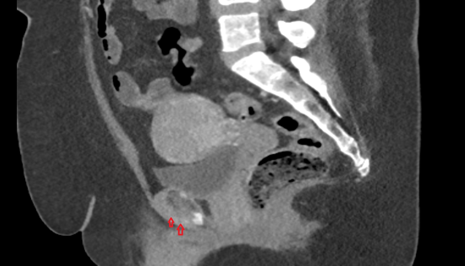 Inferior pubic ligament  CT SAG  anatomy  image-img-00000-00000