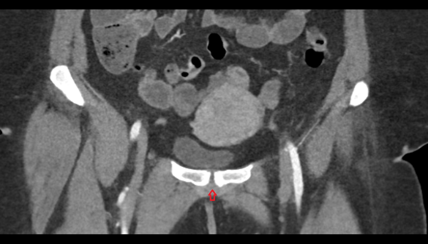Inferior pubic ligament  CT coronal  anatomy  image-img-00000-00000