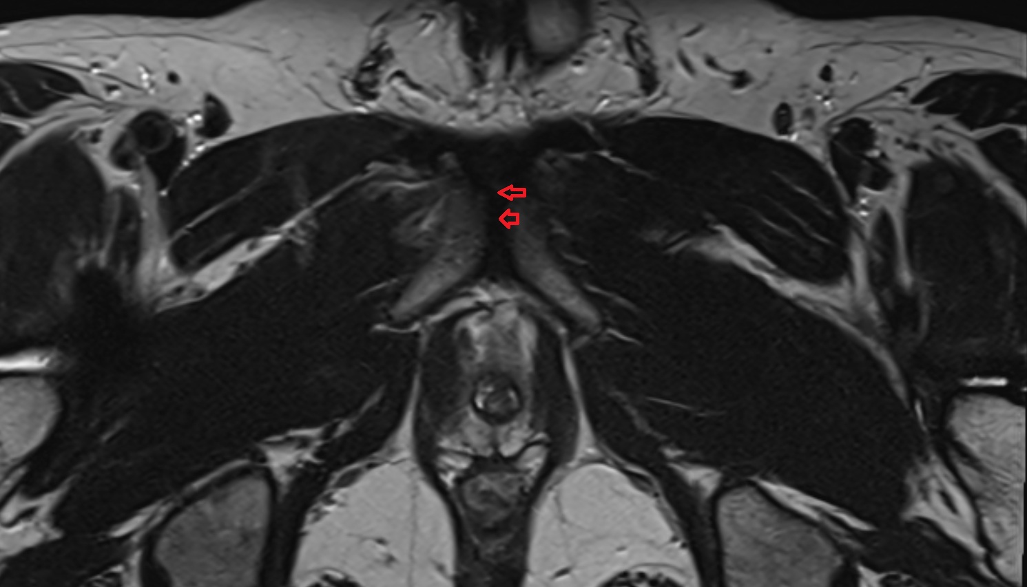 Inferior pubic ligament  MRI axial  anatomy  image-img-00000-00000