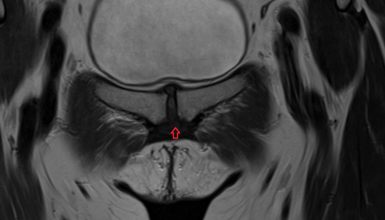 Inferior pubic ligament  MRI  coronal  anatomy  image-img-00000-00000