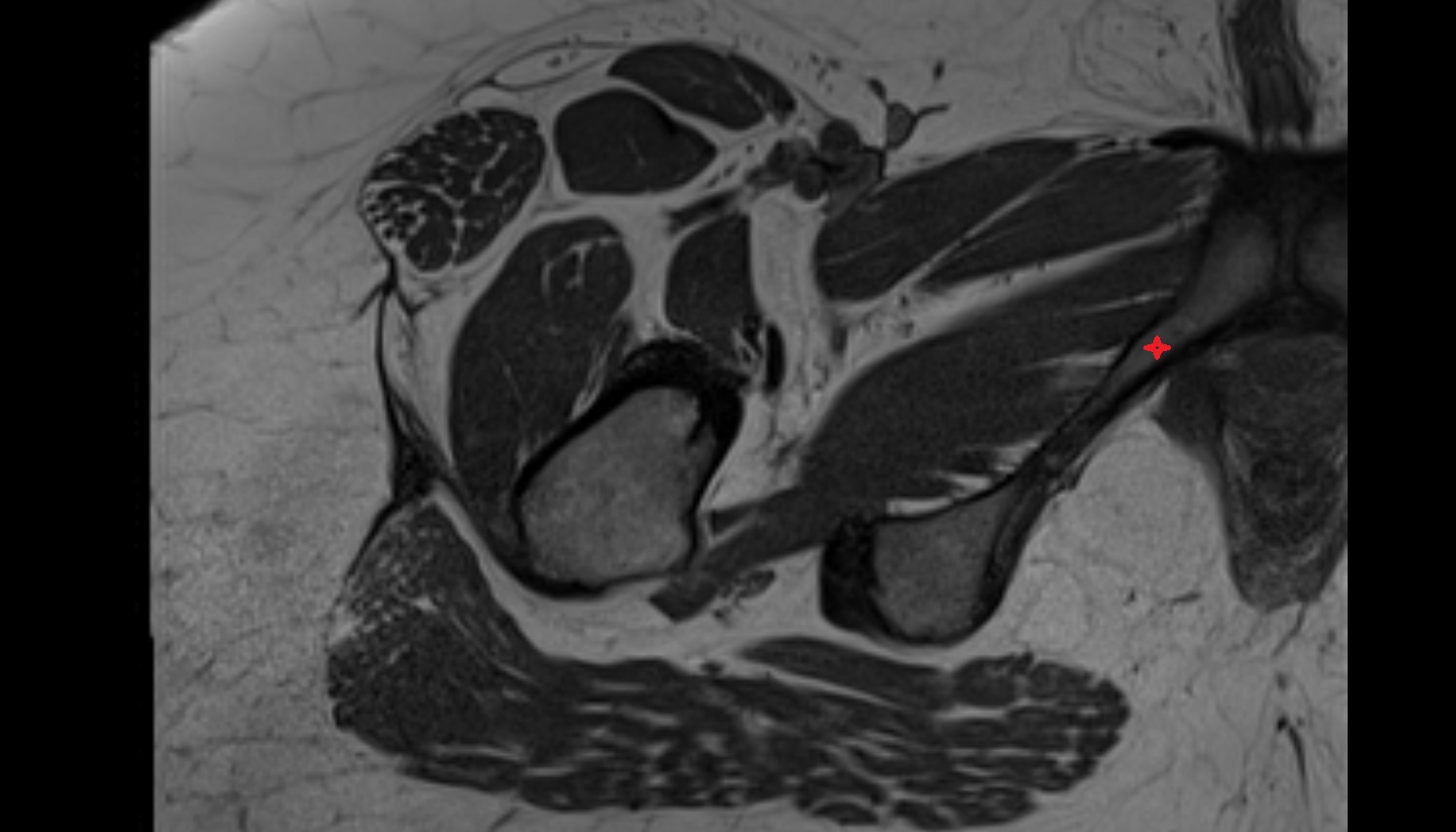 Inferior pubic ramus  MRI  axial  anatomy  image-img-00000-00000