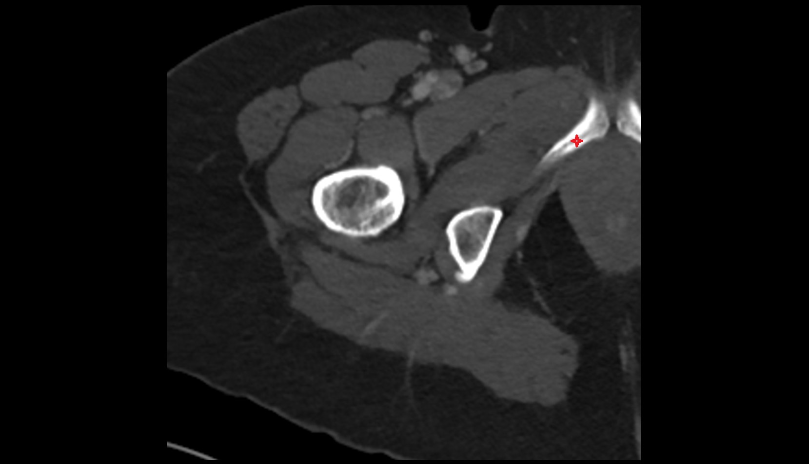 Inferior pubic ramus ct axial iamge