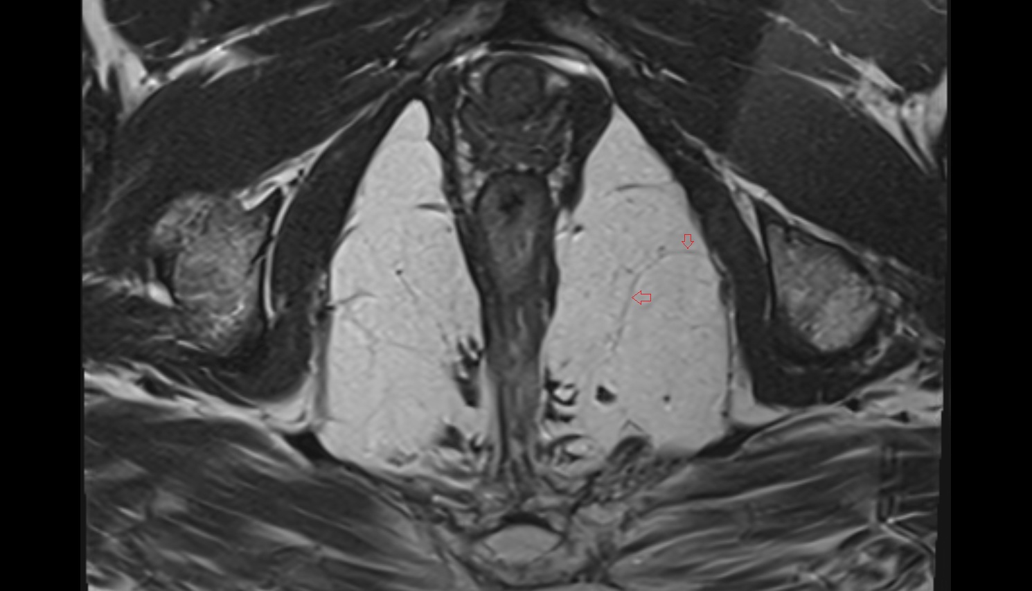 Inferior rectal nerve  mri axial  anatomy  image-img-00000-00000