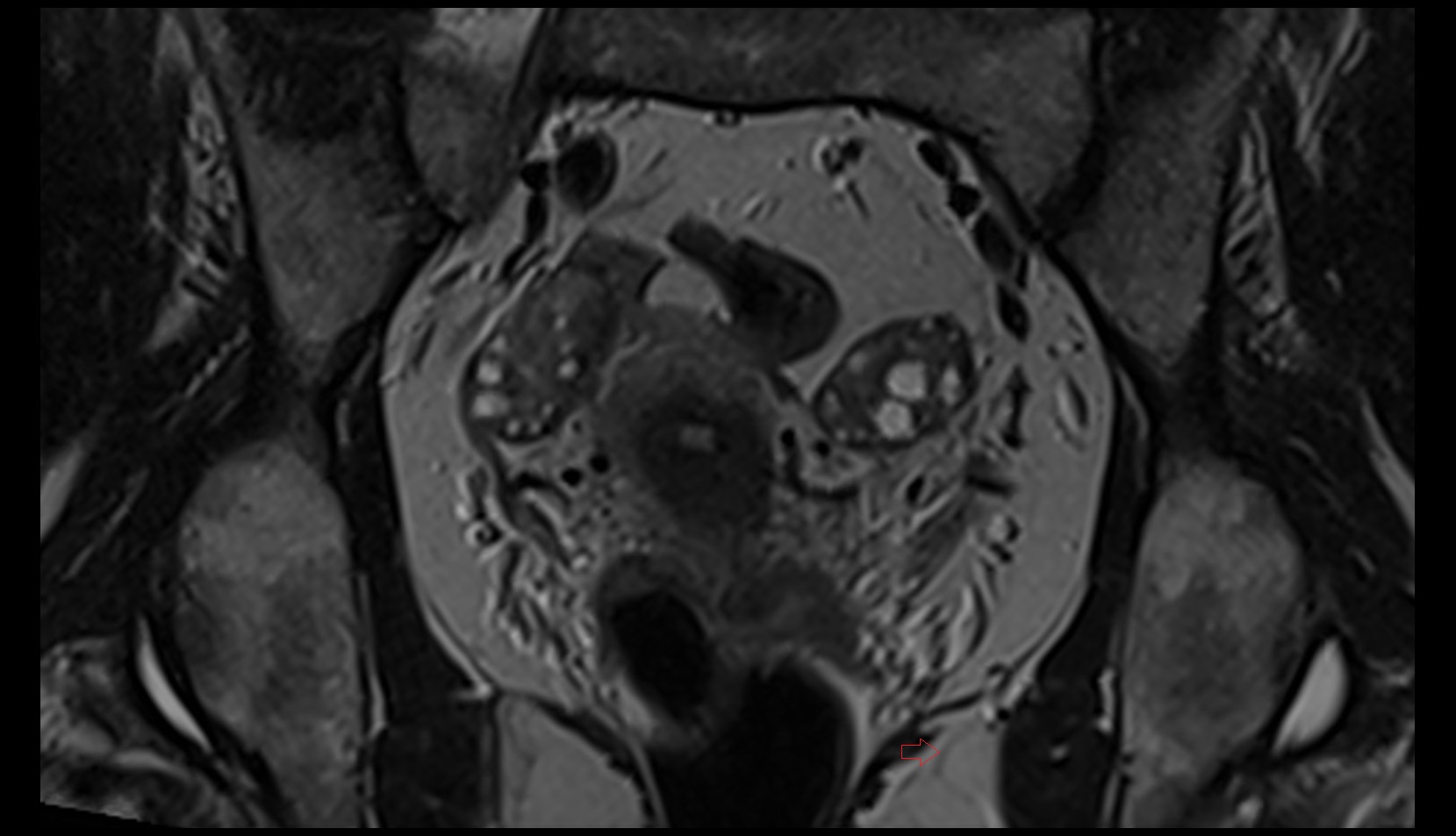 Inferior rectal nerve mri coronal image