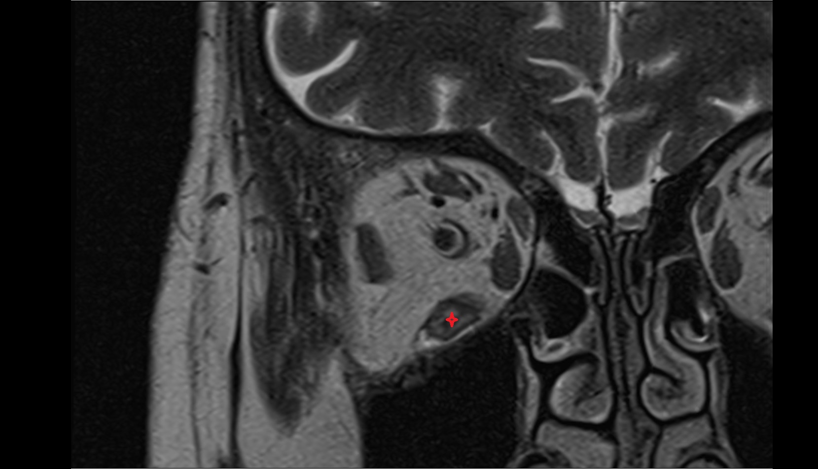 Inferior rectus muscle mri image