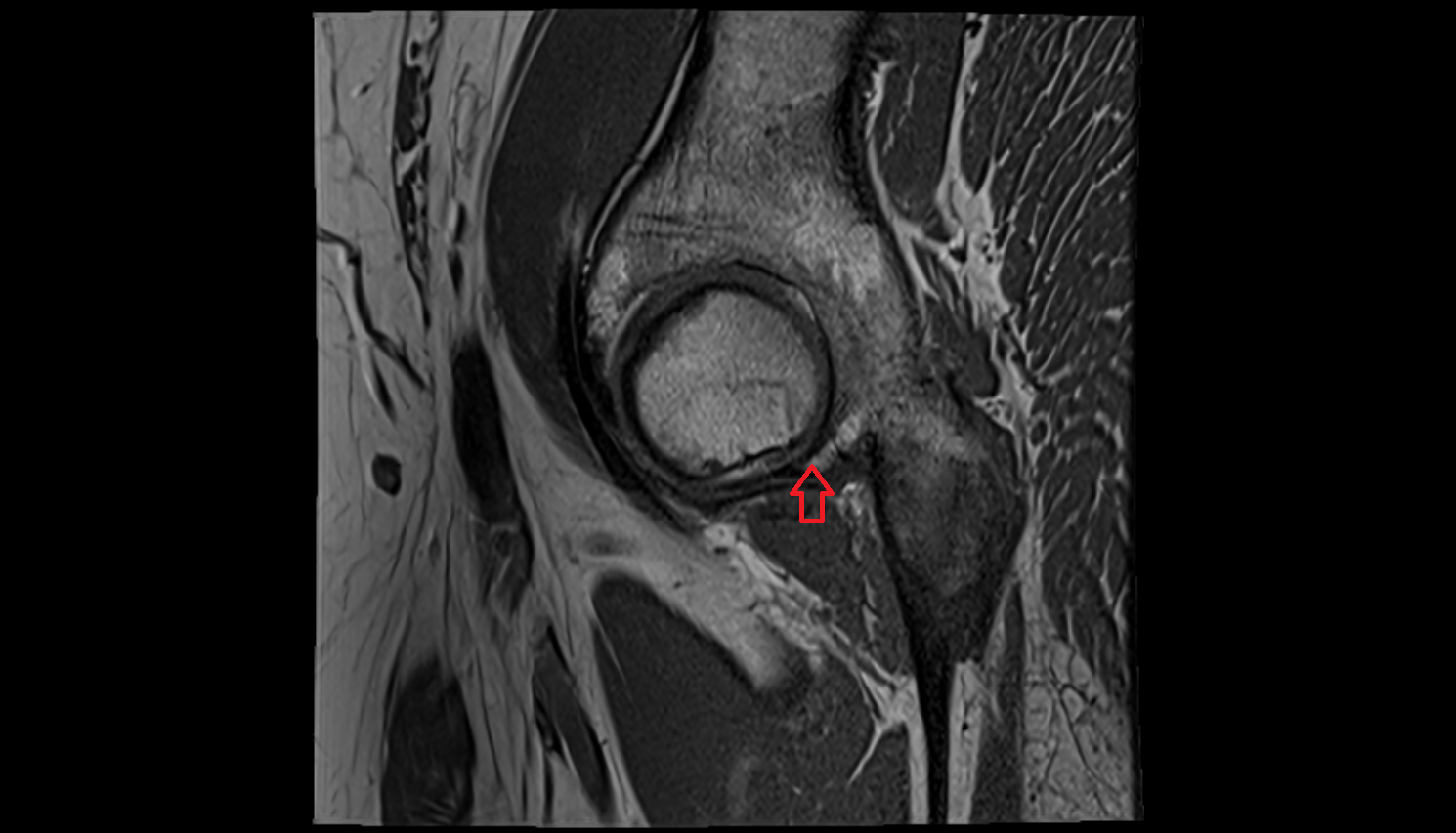 Inferior rim of acetabulum  mri  anatomy labelled image-img-00000-00000