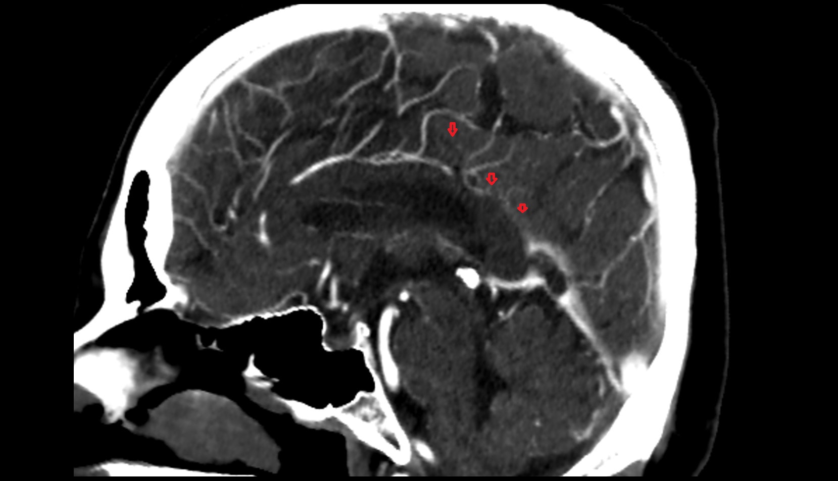Inferior sagittal sinus CT