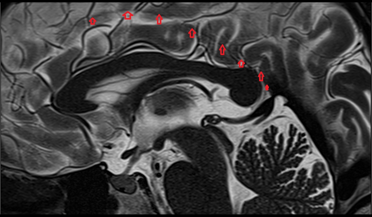 Inferior sagittal sinus MRI 3T sagittal image