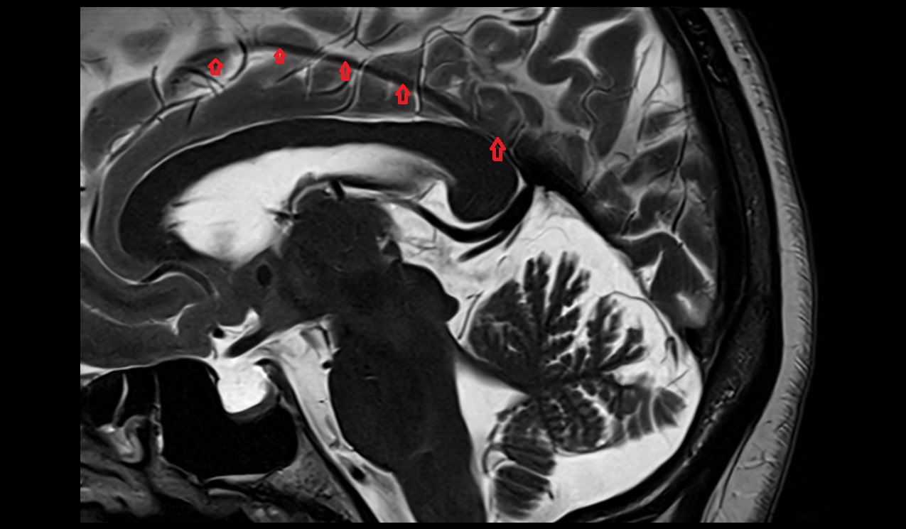 Inferior sagittal sinus  MRI 3T sagittal  image 1