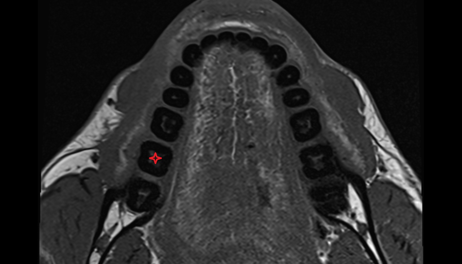 Inferior second molar tooth  mri axial  image -img-00000-00000