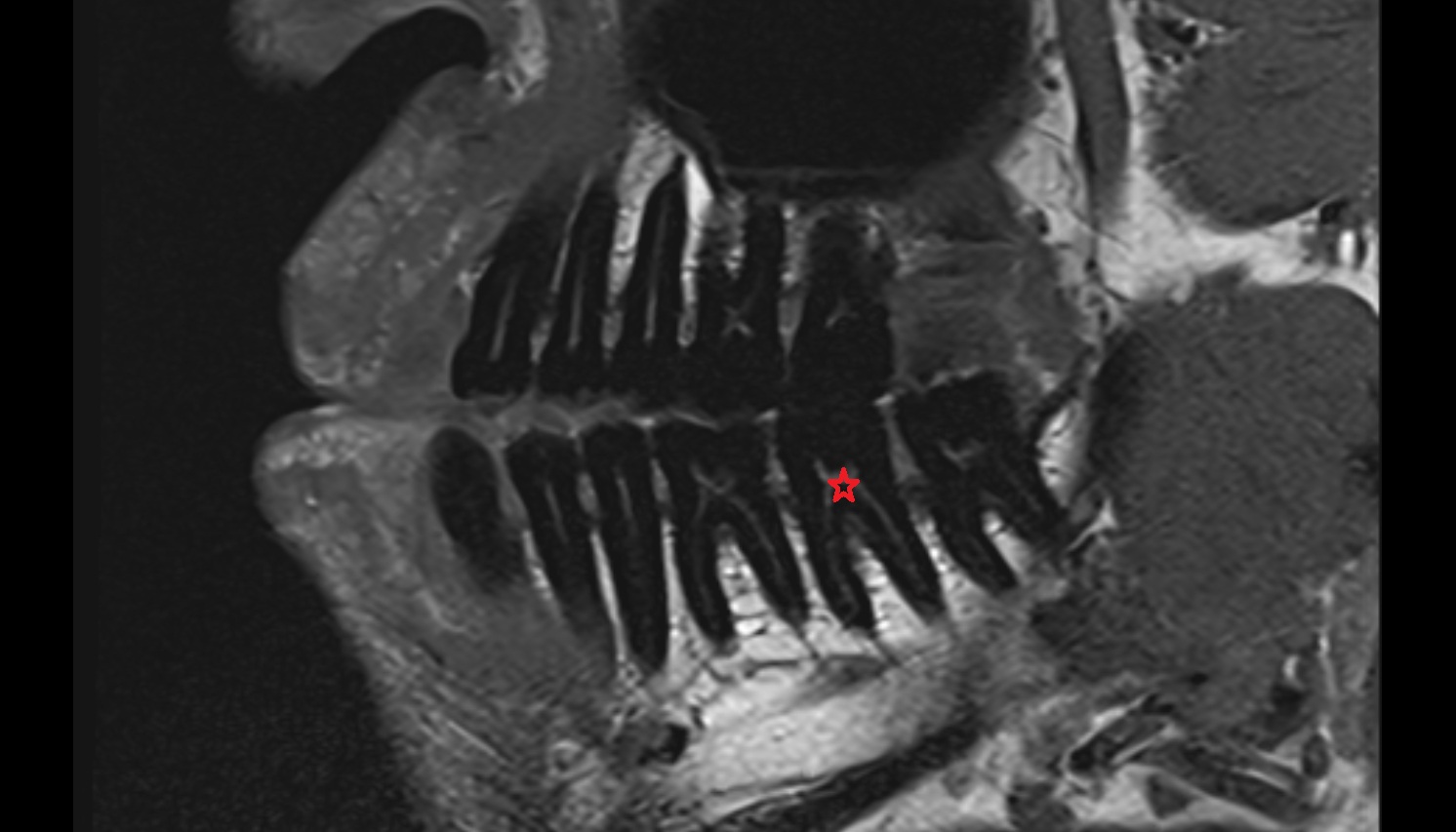 Inferior second molar tooth mri sag  image -img-00000-00000