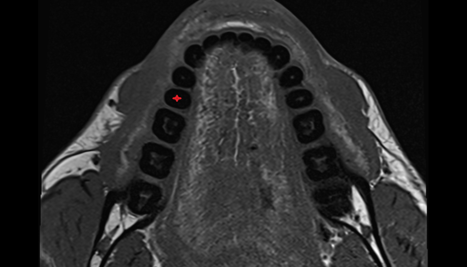 Inferior second premolar tooth  mri axial  image -img-00000-00000