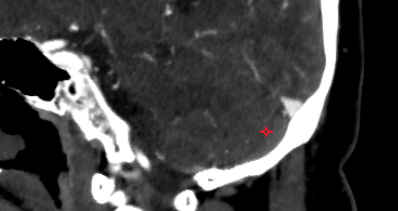 Inferior semilunar lobule  CT sag  anatomy image -img-00001-00001