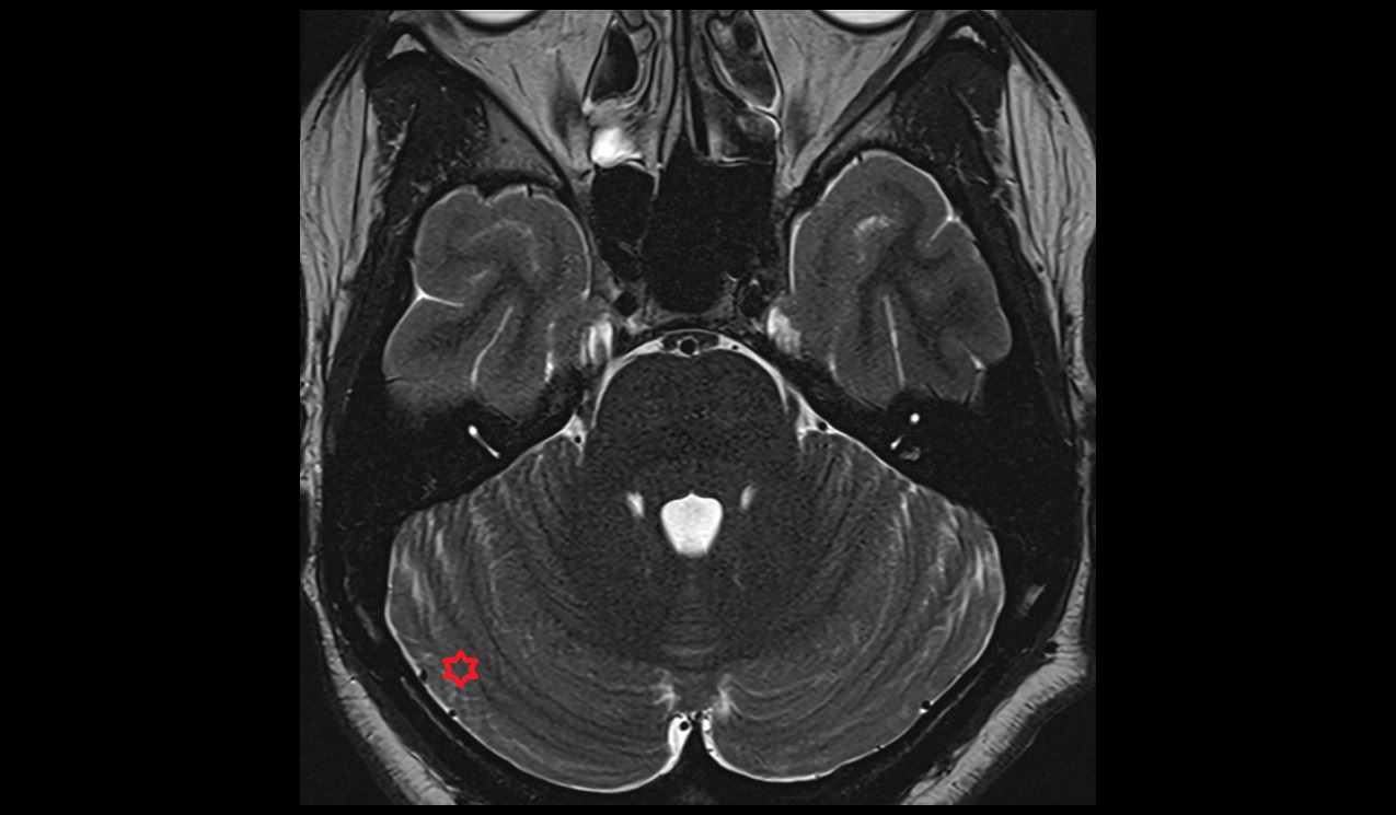 Inferior semilunar lobule MRI 3T axial  image