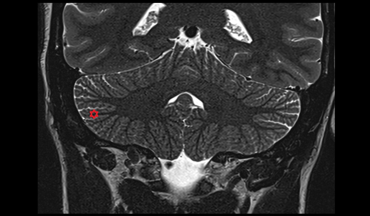 Inferior semilunar lobule MRI 3T coronal image