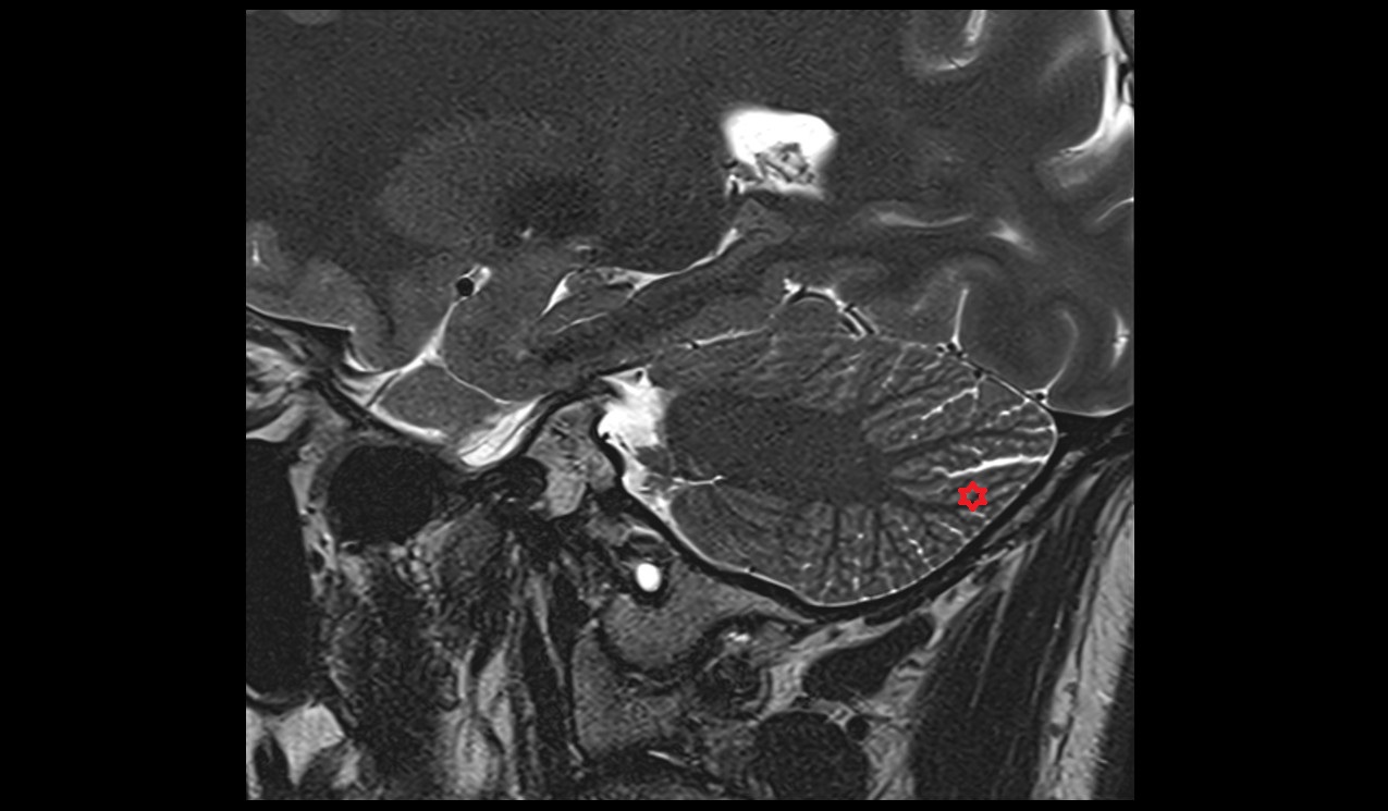 Inferior semilunar lobule MRI 3T sagittal image
