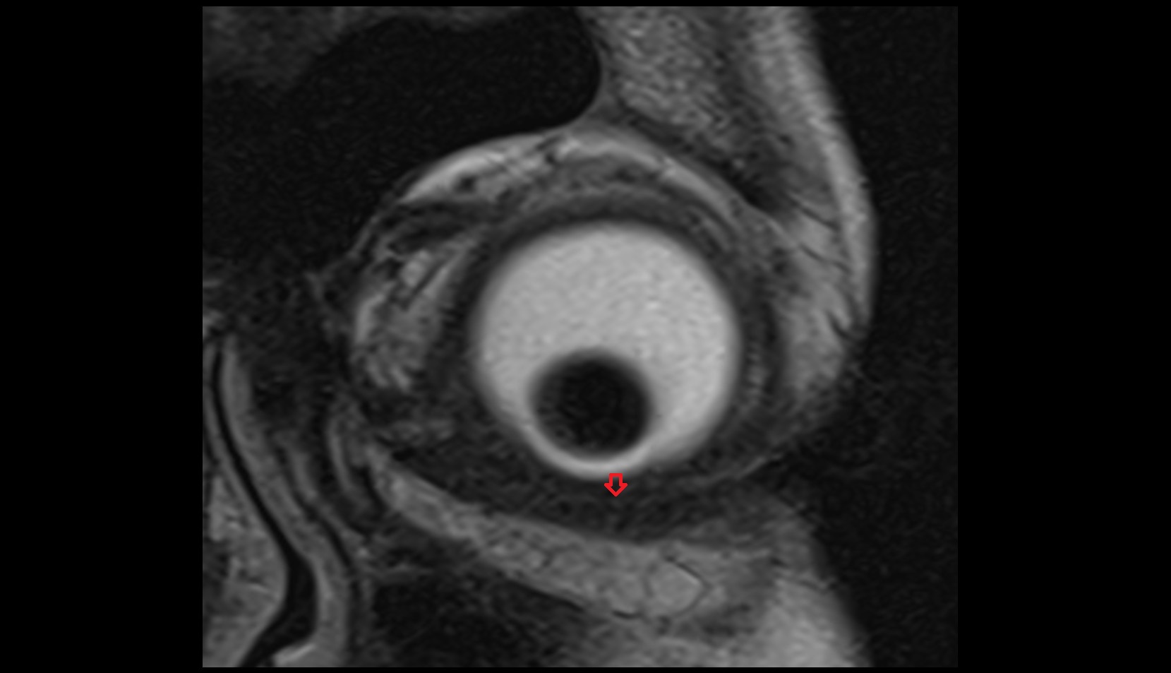 Inferior tarsus mri image