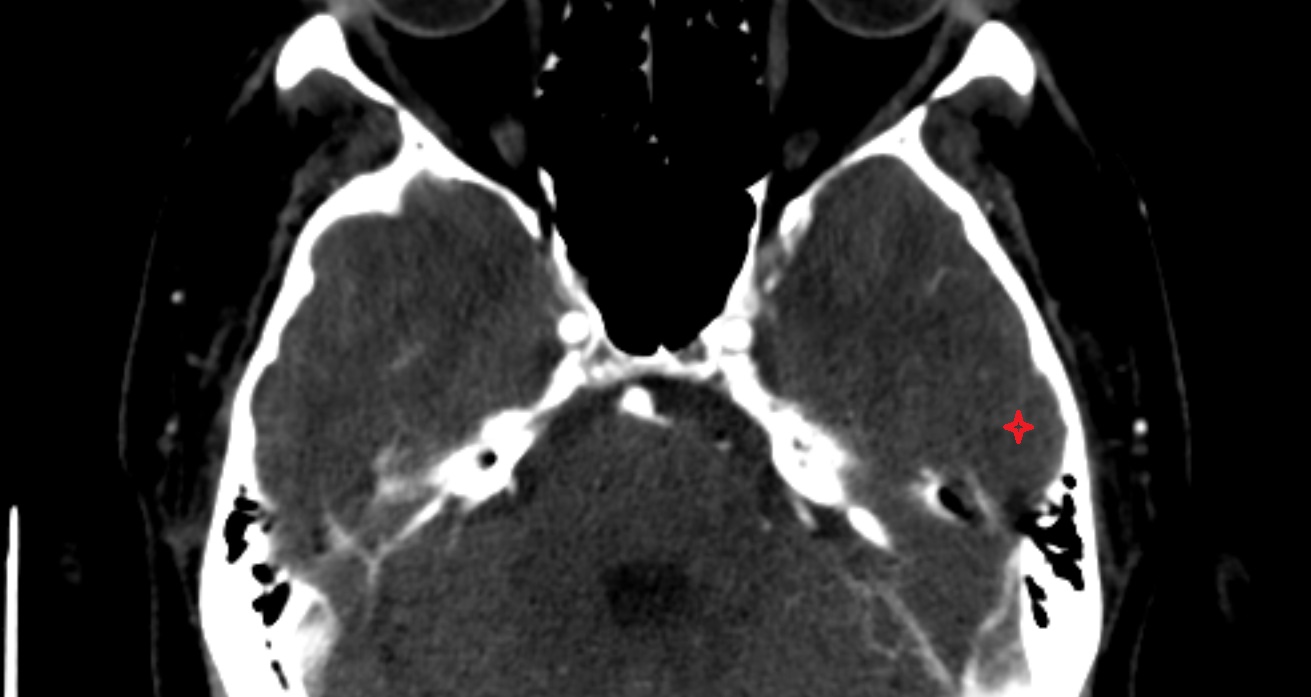 Inferior temporal gyrus  CT axial anatomy image -img-00001-00001