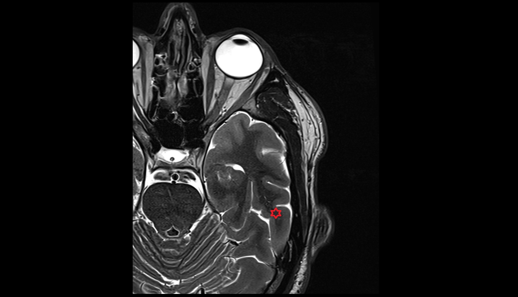 Inferior temporal gyrus mri 3t axial  image
