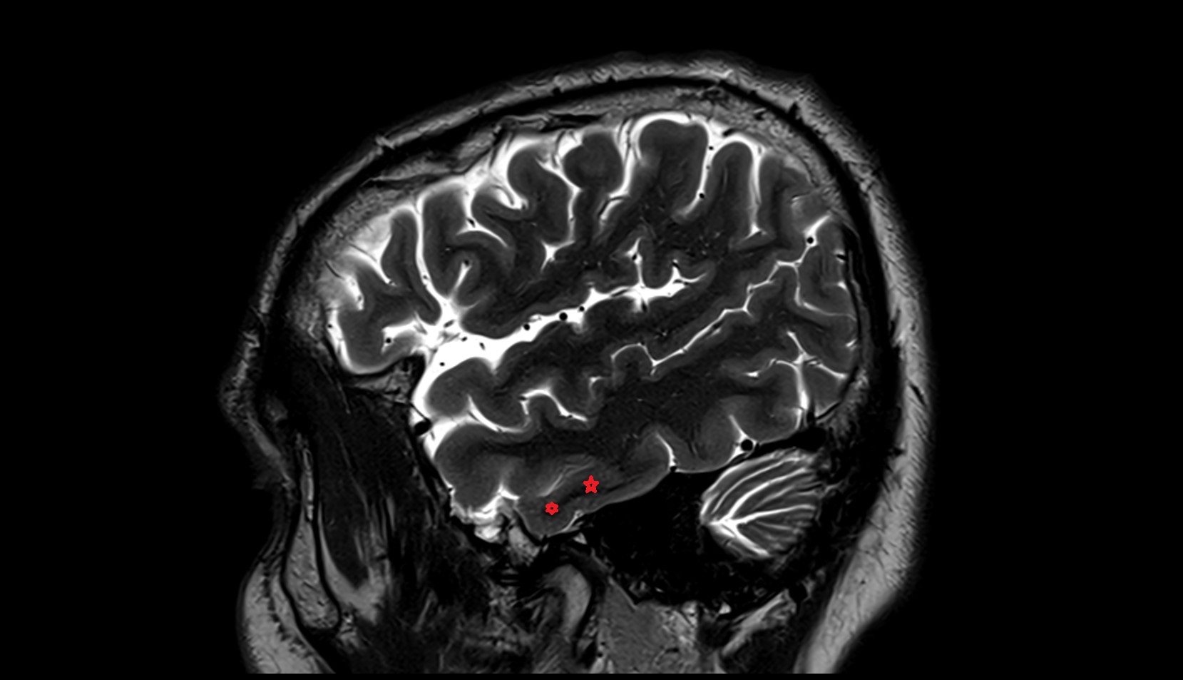 Inferior temporal gyrus mri 3t sagittal image