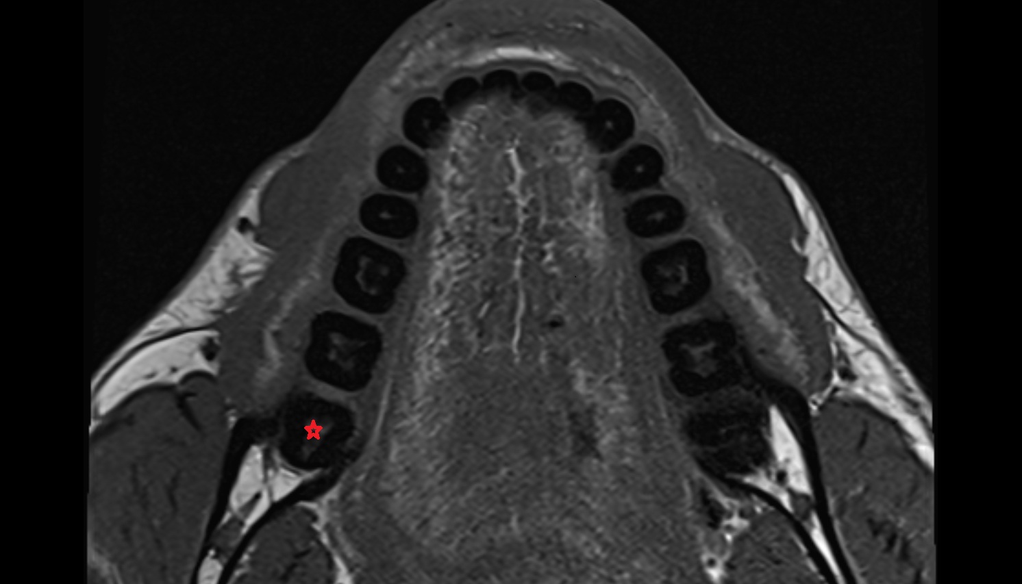 Inferior third molar tooth   mri axial  image -img-00000-00000