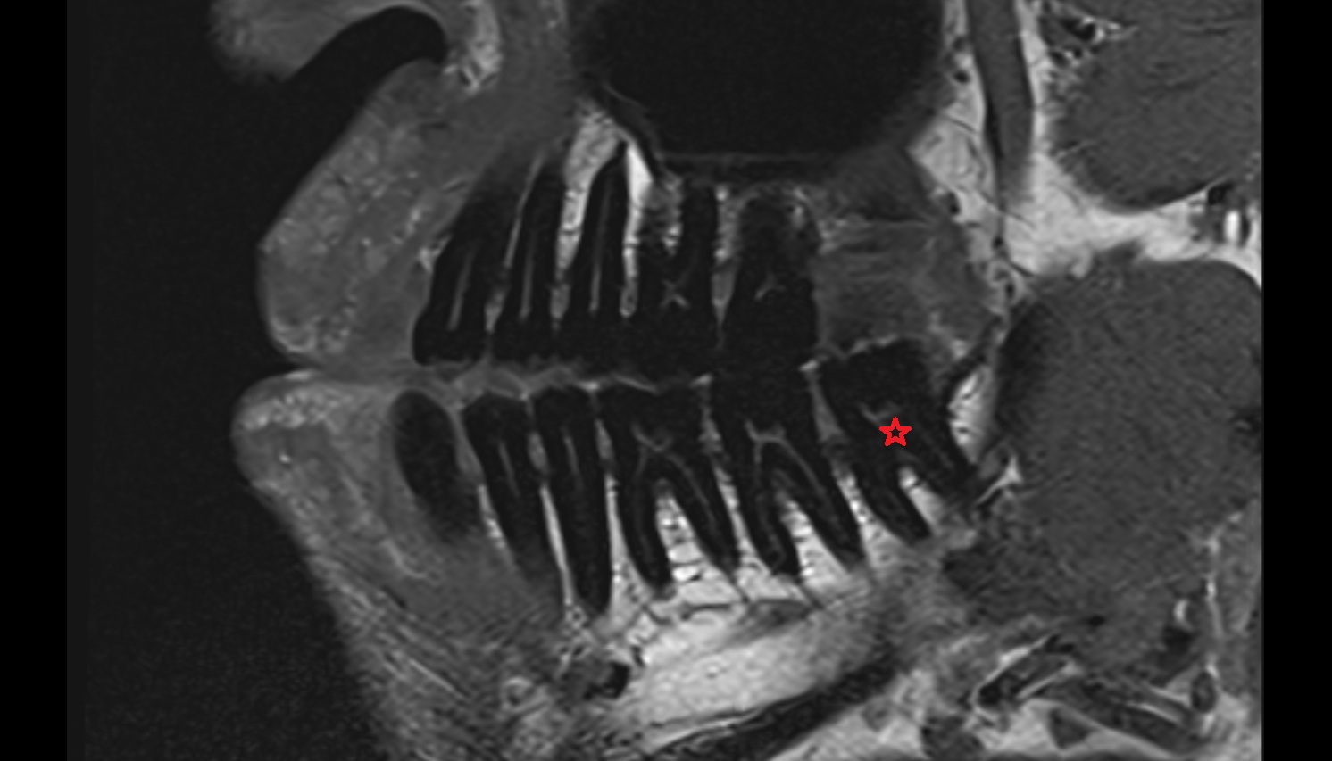 Inferior third molar tooth mri sag  image -img-00000-00000