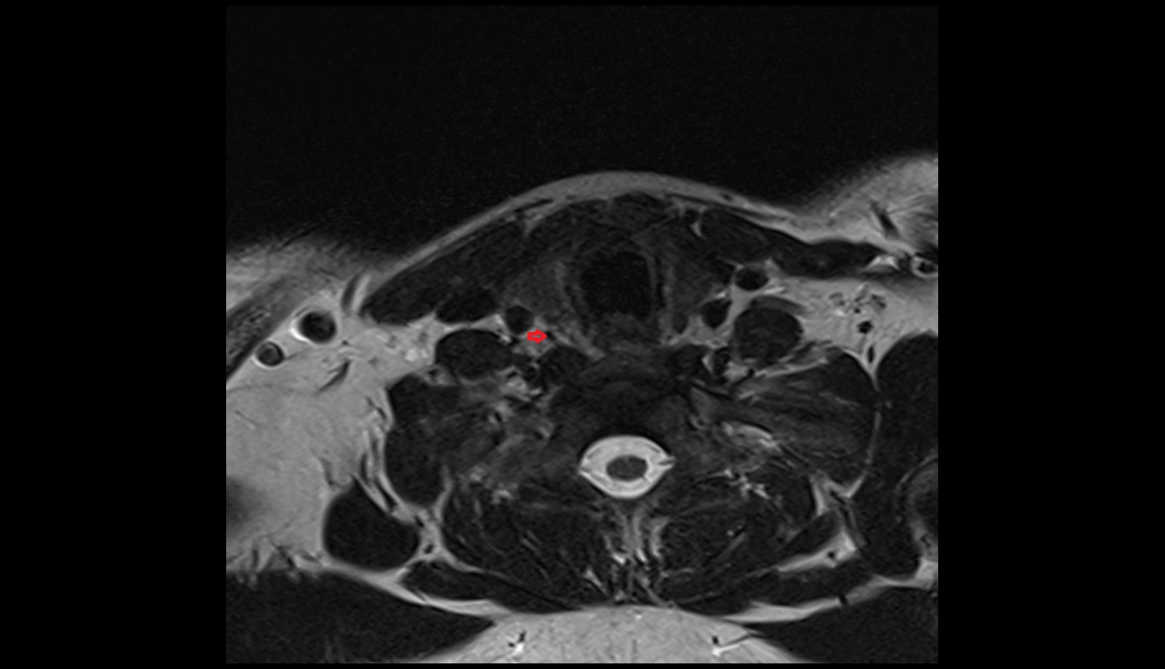Inferior thyroid artery mri axial image