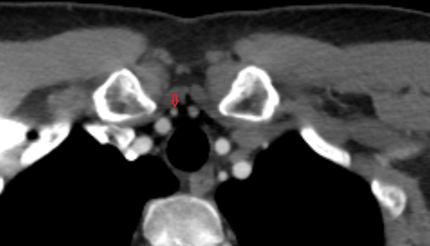 Inferior thyroid vein axial ct  image -img-00000-00000