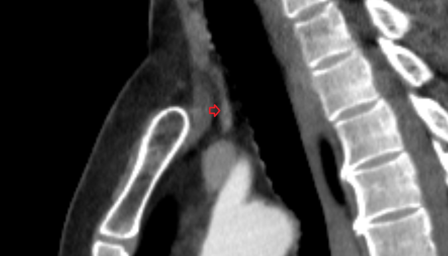 Inferior thyroid vein sag ct  image -img-00000-00000