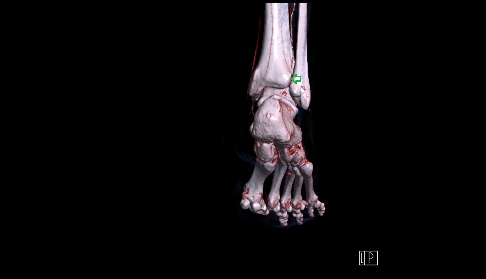 Inferior tibiofibular joint 3d