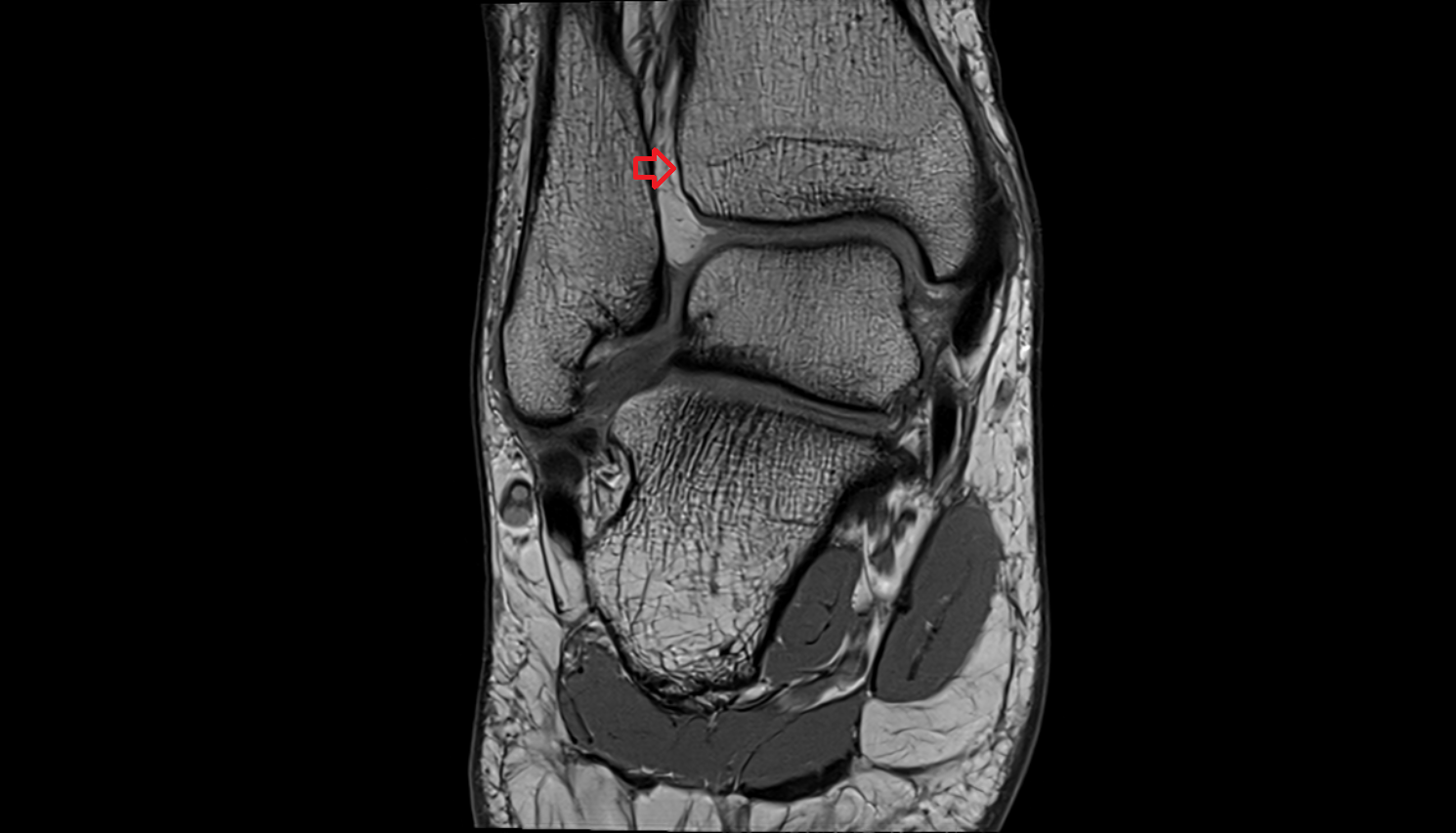 Inferior tibiofibular joint mri  anatomy labelled image-img-00000-00000