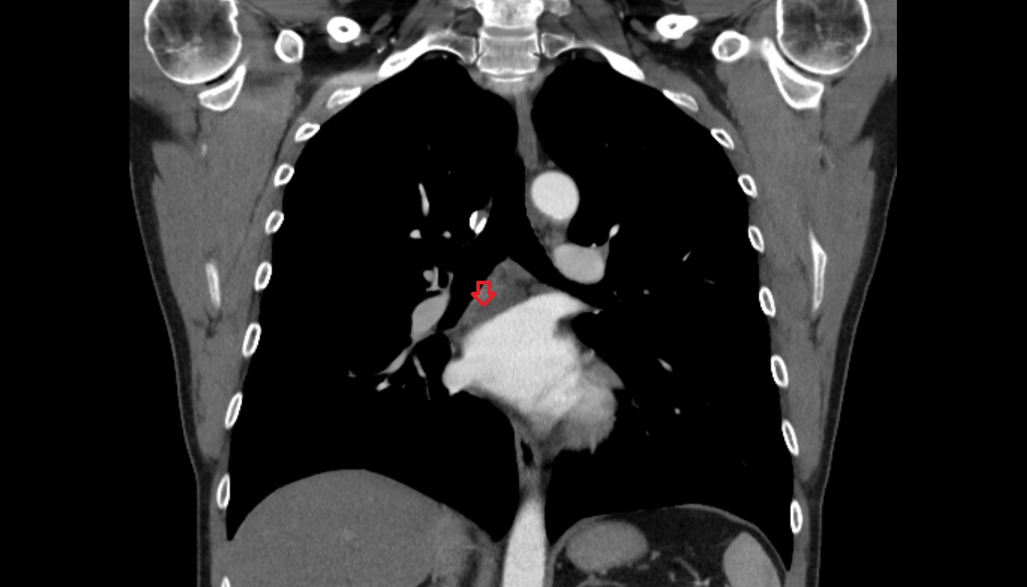 Inferior tracheobronchial  lymph nodes  anatomy CTi coronal  image -img-00000-00000