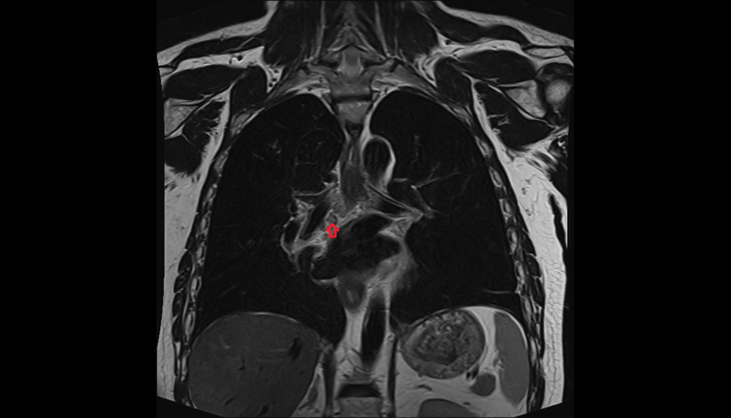 Inferior tracheobronchial lymph nodes  anatomy mri coronal  image -img-00000-00000