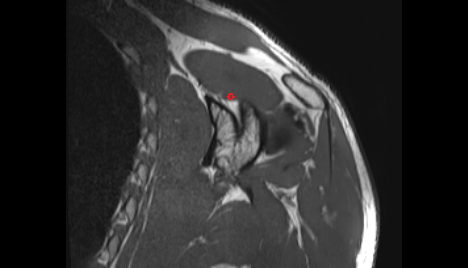 Inferior transverse scapular ligament cor cross sectional anatomy 3T MRI AI enhanced radiology image -img-00000-00000