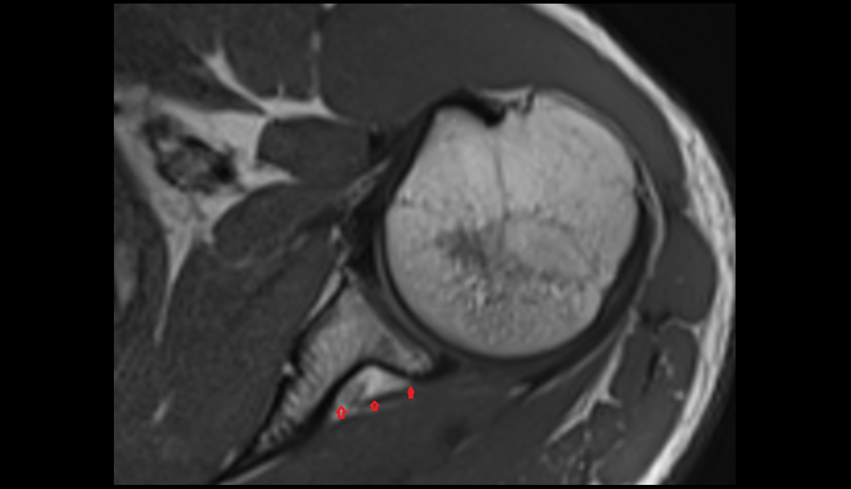 Inferior transverse scapular ligament mri axial image