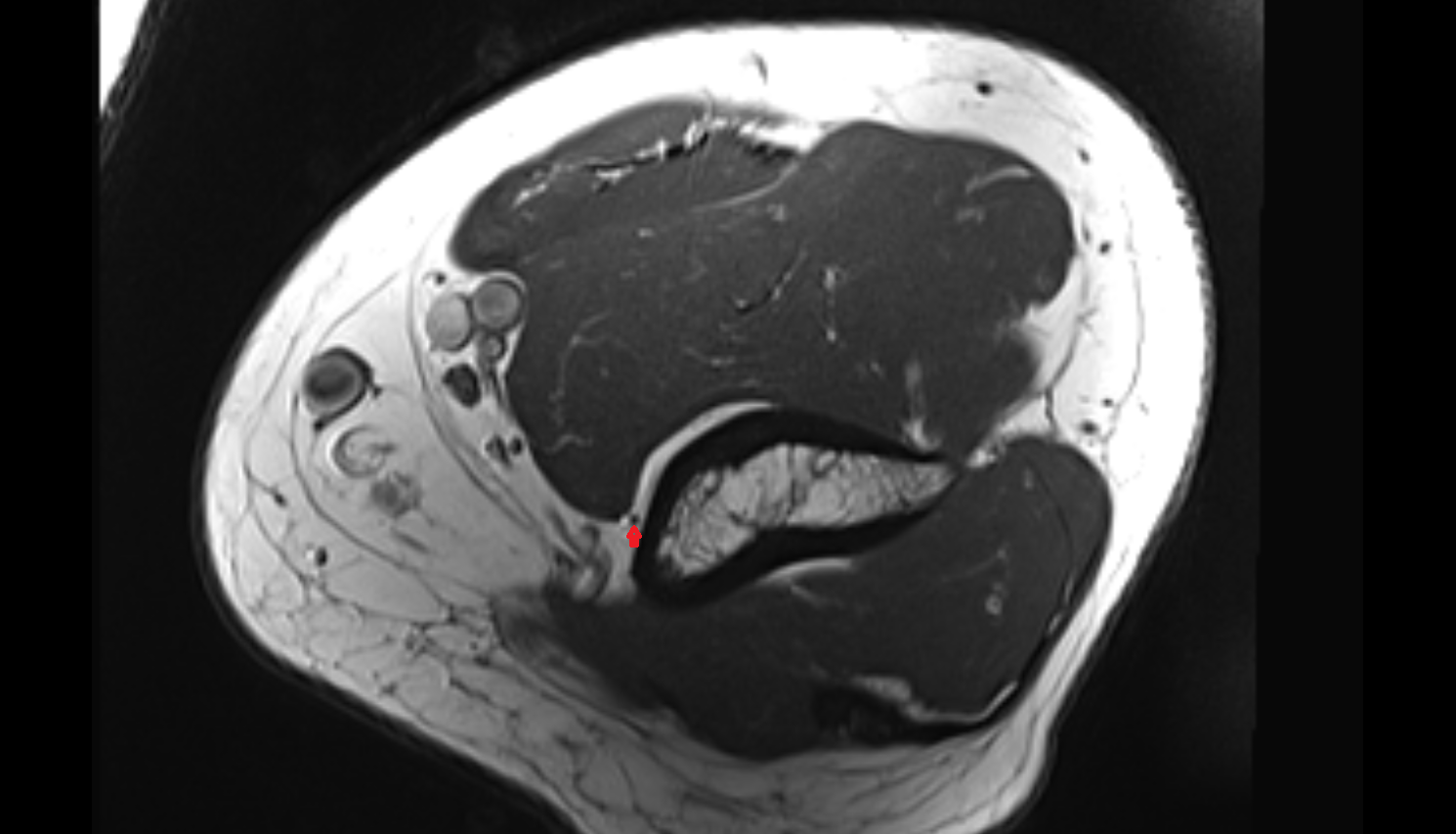 Inferior ulnar collateral artery axial cross sectional anatomy 3T MRI AI enhanced radiology image -img-00000-00000