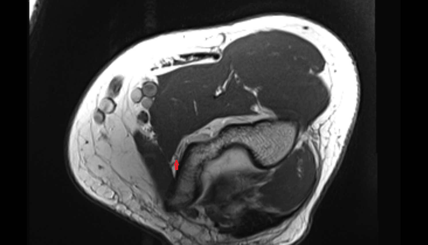 Inferior ulnar collateral artery axial cross sectional anatomy 3T MRI AI enhanced radiology image -img-00000-00000_00001