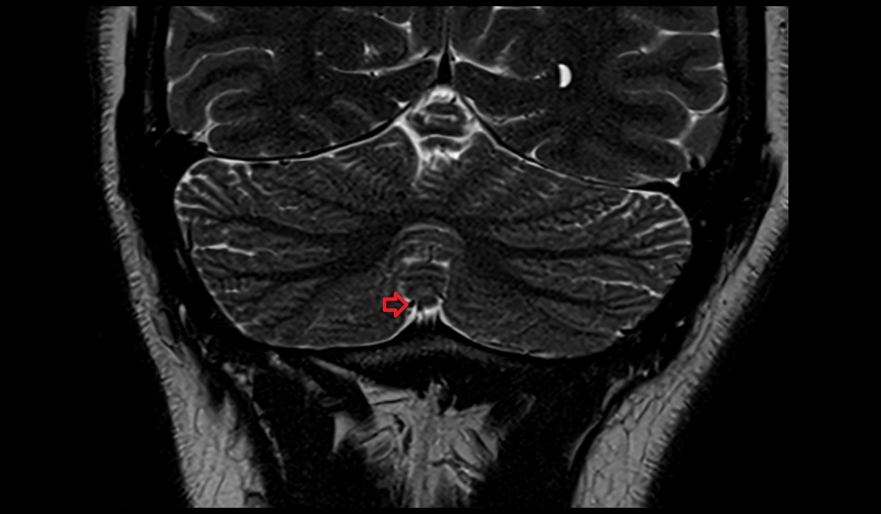 Inferior vein of vermis MRI 3T coronal image
