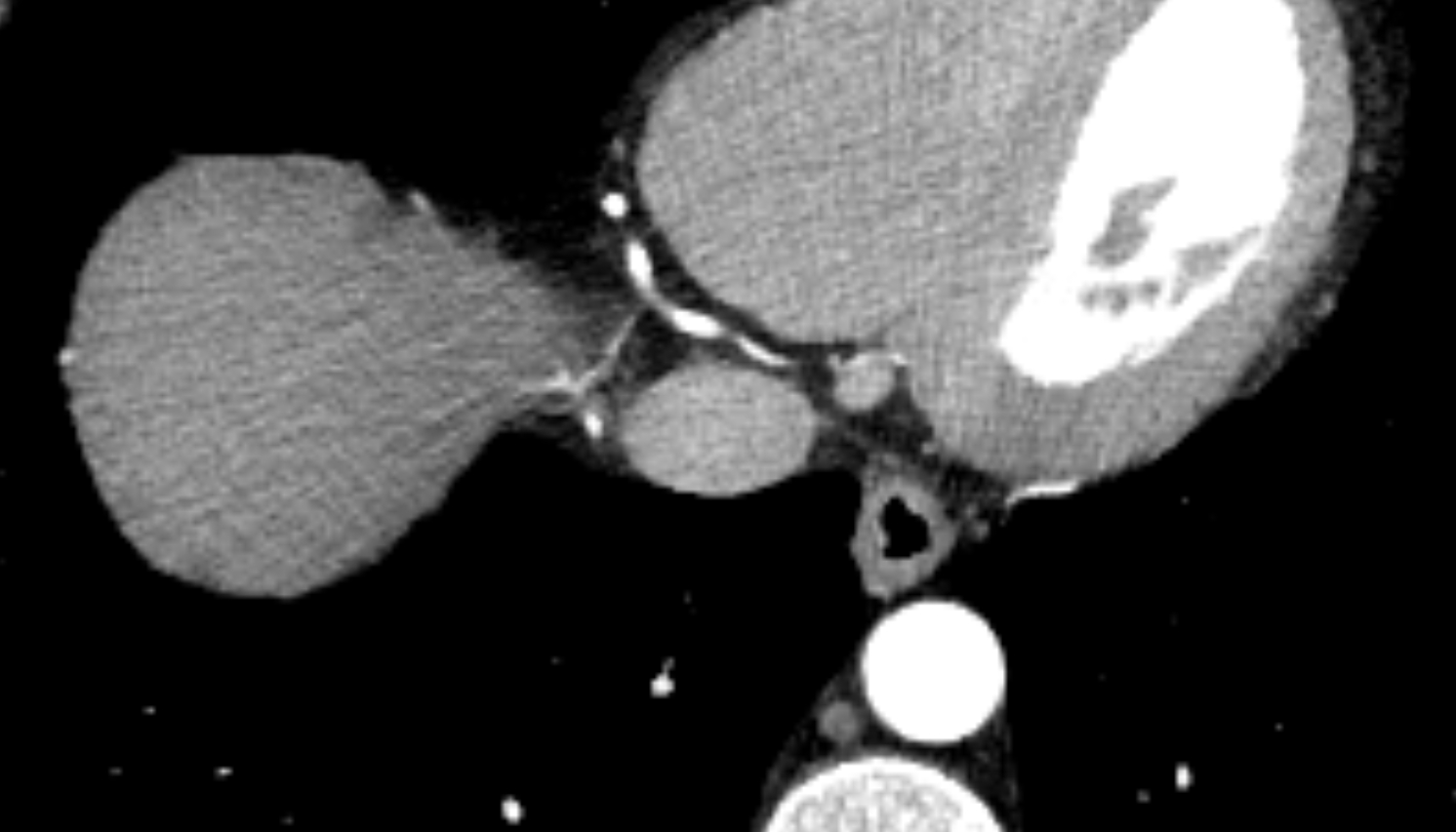 Inferior vena cava  CT  axial image -img-00000-00000