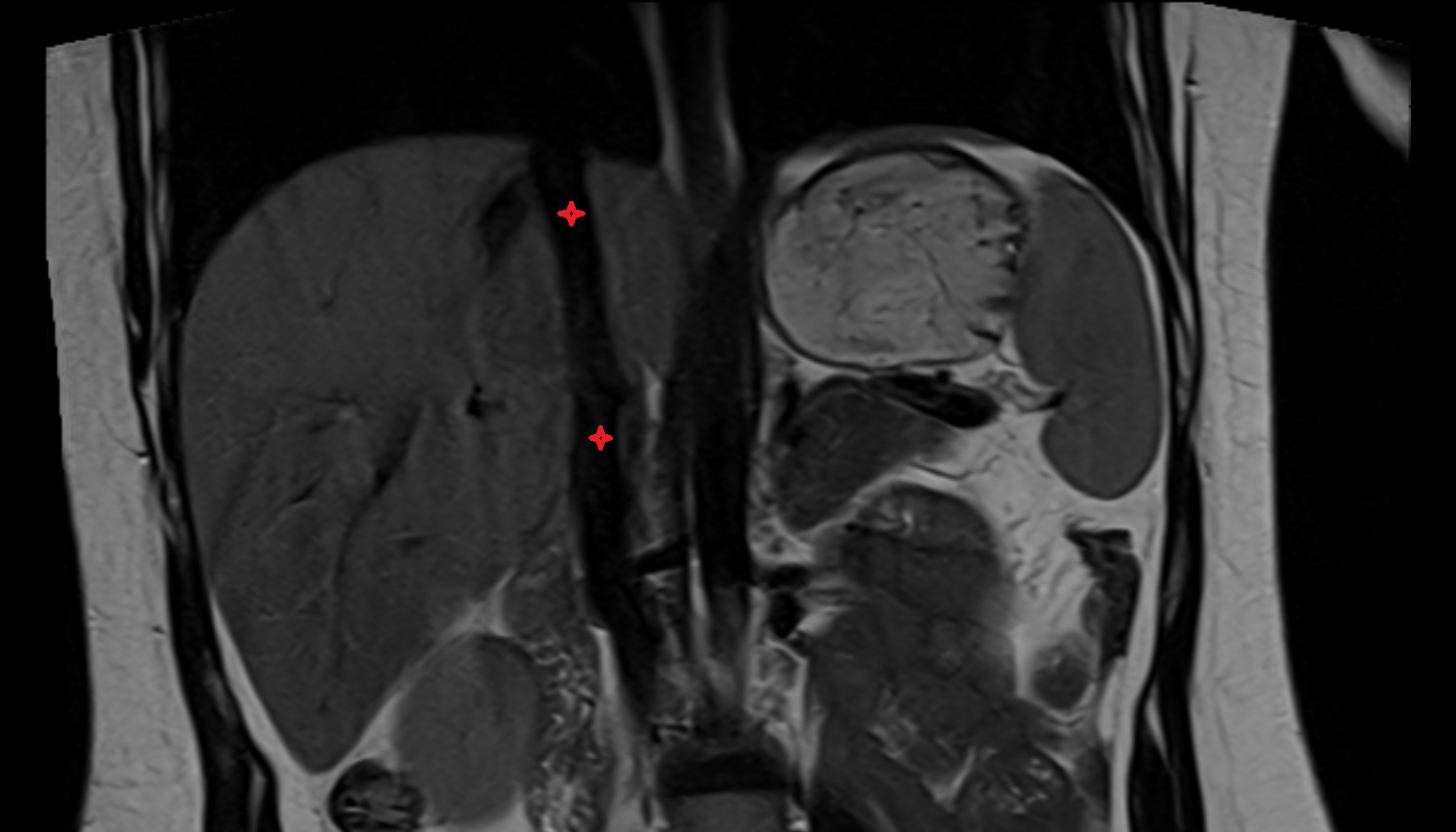 Inferior vena cava  CT  axial image -img-00000-00000_00001