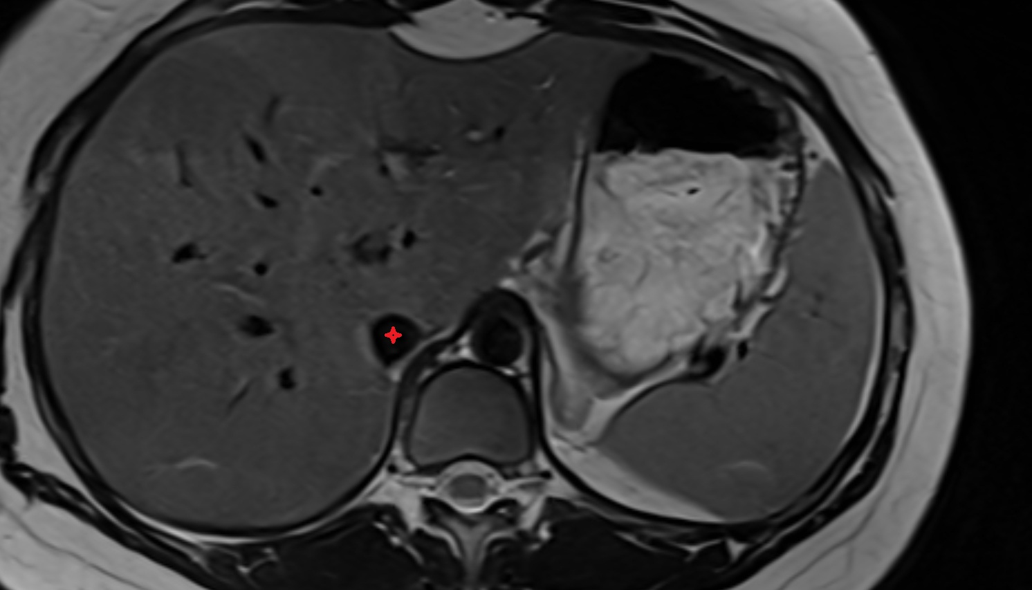 Inferior vena cava  MRI  axial image -img-00000-00000