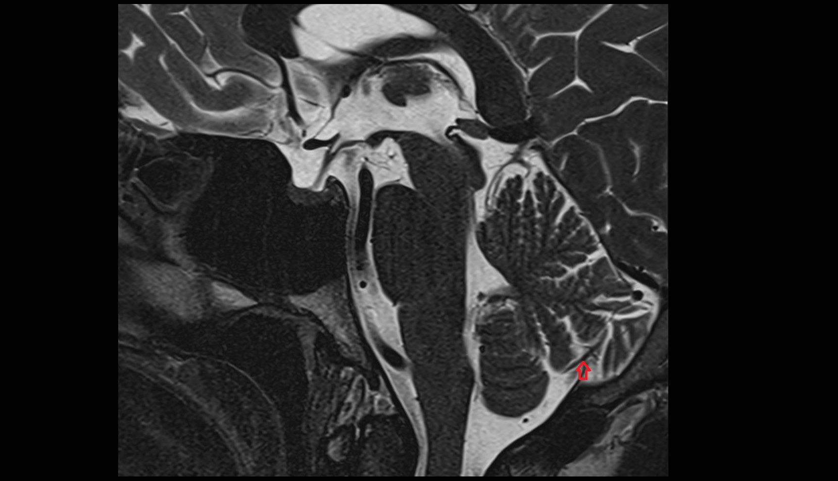 Inferior vermian vein mri sag image