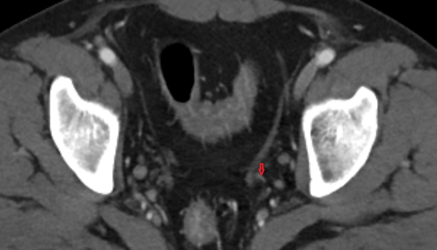 Inferior vesical artery  ct axial  image   CT axial anatomy  image-img-00000-00000