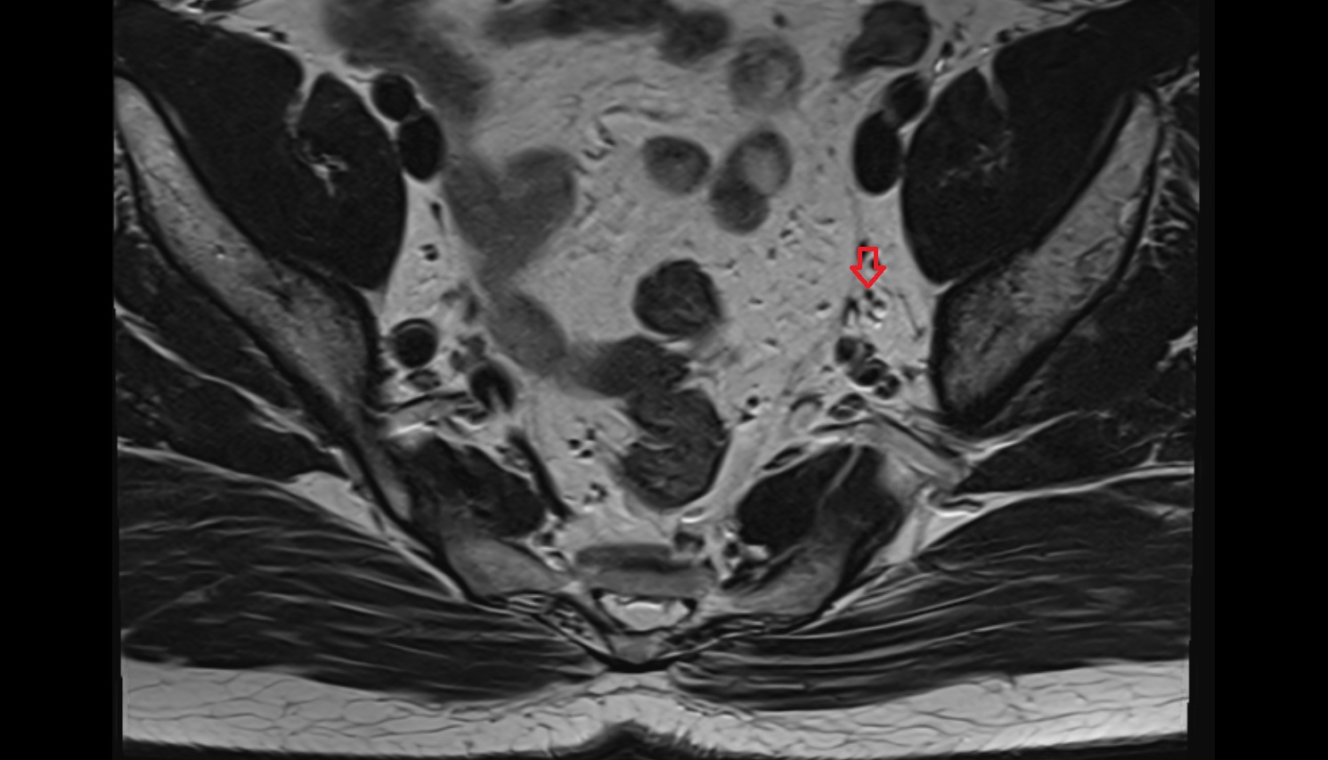 Inferior vesical artery  mri axial  image   CT axial anatomy  image-img-00000-00000