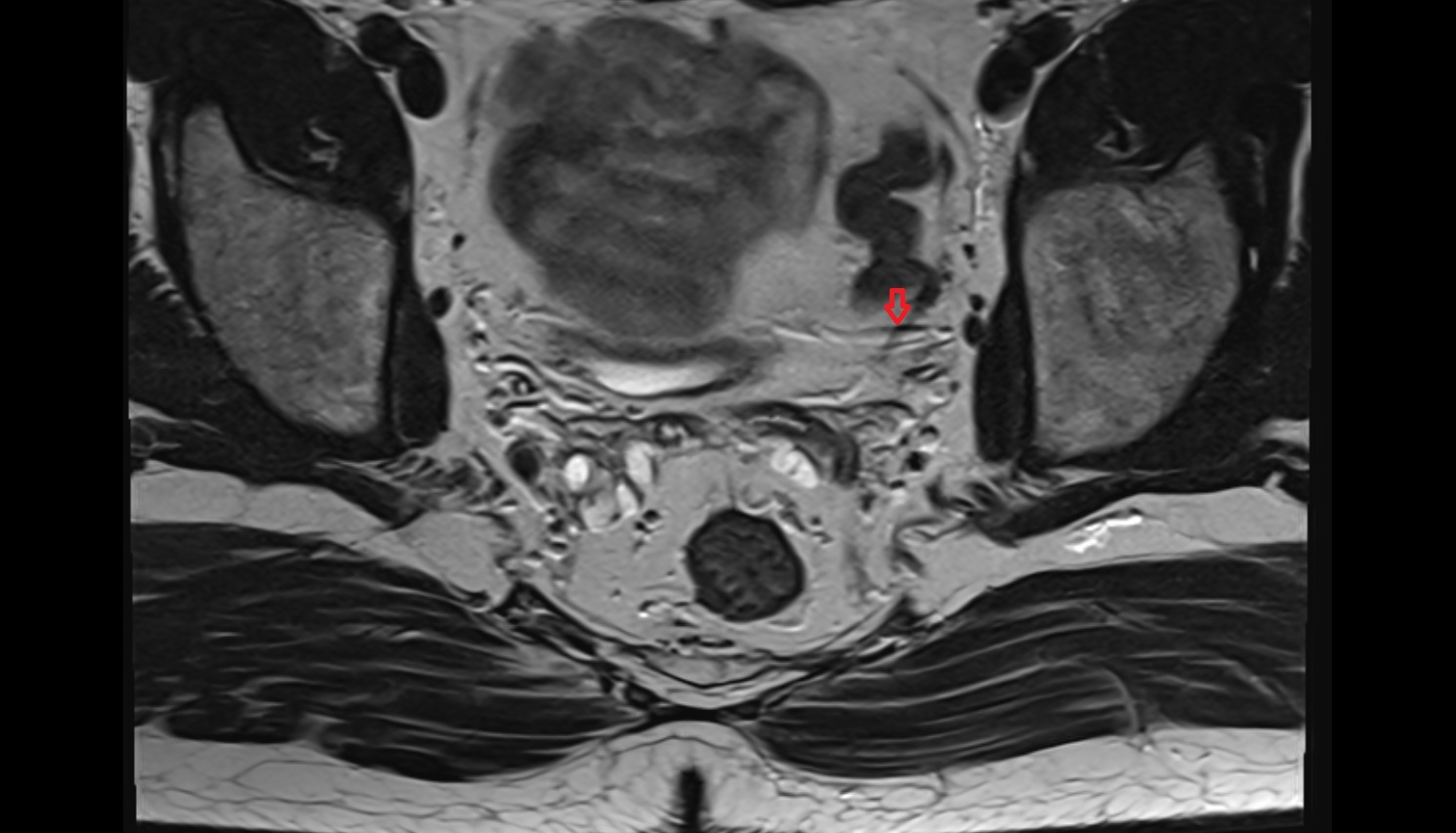 Inferior vesical artery  mri axial  image   CT axial anatomy  image-img-00000-00000_00001