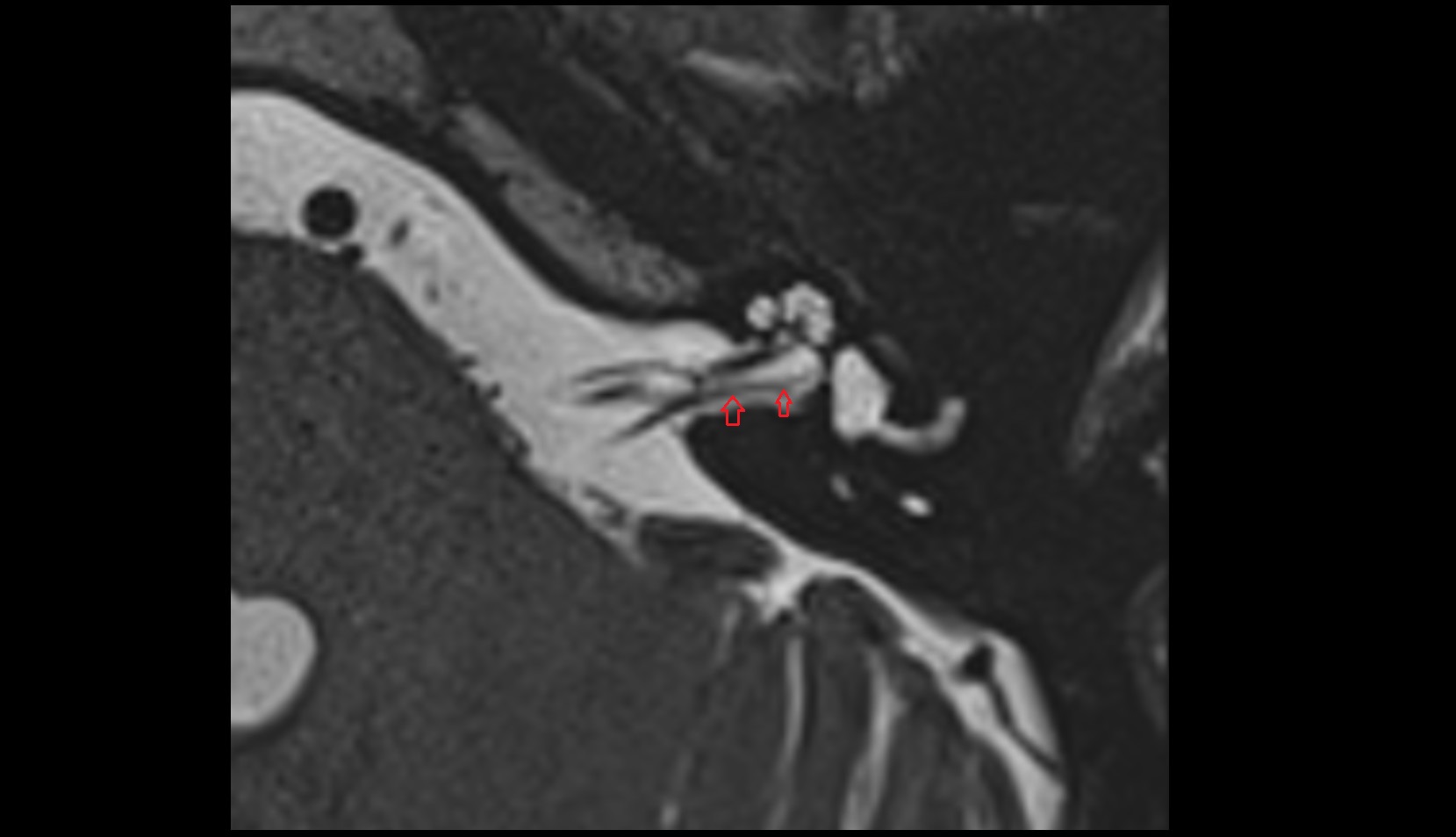 Inferior vestibular nerve MRI axial image